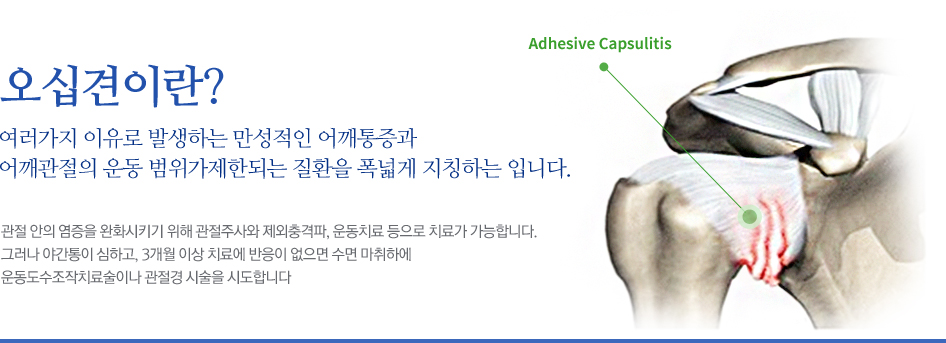 오십견이란? 여러가지 이유로 발생하는 만성적인 어깨통증과 어깨관절의 운동 범위가제한되는 질환을 폭넓게 지칭하는 입니다. 관절 안의 염증을 완화시키기 위해 관절주사와 제외충격파, 운동치료 등으로 치료가 가능합니다. 그러나 야간통이 심하고, 3개월 이상 치료에 반응이 없으면 수면 마취하에 운동도수조작치료술이나 관절경 시술을 시도합니다