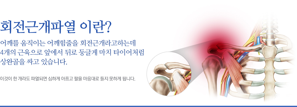 회전근개파열 이란? 어깨를 움직이는 어깨힘줄을 회전근개라고하는데 4개의 근육으로 앞에서 뒤로 둥글게 마치 타이어처럼 상완골을 싸고 있습니다. 이것이 한 개라도 파열되면 심하게 아프고 팔을 마음대로 들지 못하게 됩니다.
