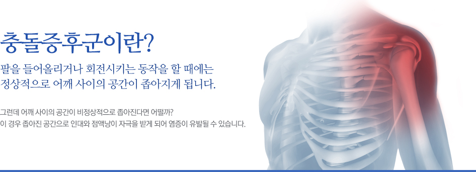 충돌증후군이란? 팔을 들어올리거나 회전시키는 동작을 할 때에는 정상적으로 어깨 사이의 공간이 좁아지게 됩니다. 그런데 어깨 사이의 공간이 비정상적으로 좁아진다면 어떨까? 이 경우 좁아진 공간으로 인대와 점액낭이 자극을 받게 되어 염증이 유발될 수 있습니다.