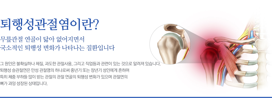 퇴행성관절염이란? 무릎관절 연골이 닳아 없어지면서 국소적인 퇴행성 변화가 나타나는 질환입니다. 그 원인은 불확실하나 체질, 과도한 관절사용, 그리고 직업등과 관련이 있는 것으로 알려져 있습니다. 퇴행성 슬관절연은 만성 관절염의 하나로써 중년기 또는 장년기 성인에게 흔하며 특히 체중 부하들 많이 받는 관절의 관절 연골의 퇴행성 변화가 있으며 관절면의 뼈가 과잉 성장된 상태입니다. 