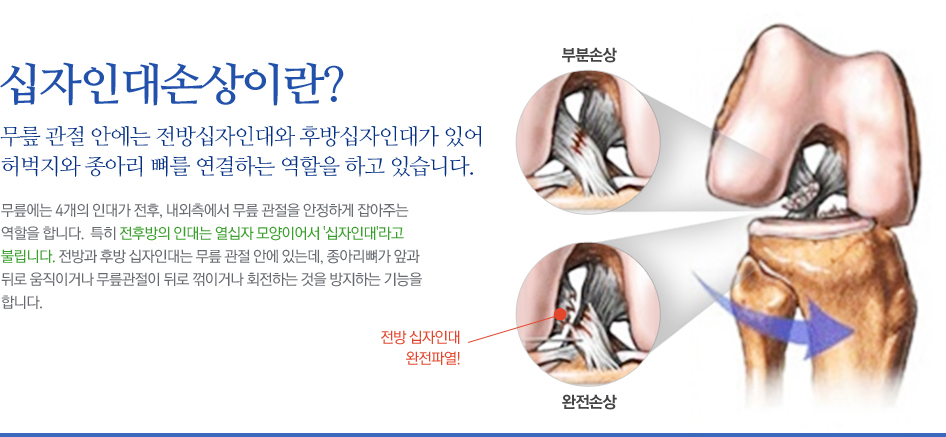 십자인대손상이란? 무릎 관절 안에는 전방십자인대와 후방십자인대가 있어 허벅지와 종아리 뼈를 연결하는 역할을 하고 있습니다. 무릎에는 4개의 인대가 전후, 내외측에서 무릎 관절을 안정하게 잡아주는 역할을 합니다.  특히 전후방의 인대는 열십자 모양이어서 '십자인대'라고 불립니다. 전방과 후방 십자인대는 무릎 관절 안에 있는데, 종아리뼈가 앞과 뒤로 움직이거나 무릎관절이 뒤로 꺾이거나 회전하는 것을 방지하는 기능을 합니다.