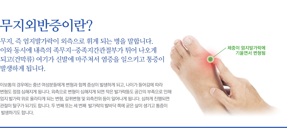 무지외반증이란? 무지, 즉 엄지발가락이 외측으로 휘게 되는 병을 말합니다. 이와 동시에 내측의 족무지-중족지간관절부가 튀어 나오게 되고(건막류) 여기가 신발에 마주쳐서 염증을 일으키고 통증이 발생하게 됩니다. 이보통의 경우에는 중년 여성분들에게 변형과 함께 증상이 발생하게 되고, 나이가 들어감에 따라 변형도 점점 심해지게 됩니다. 외측으로 변형이 심해지게 되면 작은 발가락들도 공간의 부족으로 인해 엄지 발가락 위로 올라타게 되는 변형, 갈퀴변형 및 외측전위 등이 일어나게 됩니다. 심하게 진행되면 관절이 탈구가 되기도 합니다. 두 번째 또는 세 번째  발가락의 발바닥 쪽에 굳은 살이 생기고 통증이 발생하기도 합니다.