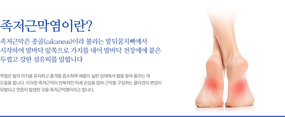 족저근막염이란? 족저근막은 종골(calcaneus)이라 불리는 발뒤꿈치뼈에서 시작하여 발바닥 앞쪽으로 가지를 내어 발바닥 전장에에 붙은 두껍고 강한 섬유띠를 말합니다. 역할은 발의 아치를 유지하고 충격을 흡수하며 체중이 실린 상태에서 발을 들어 올리는 데 도움을 줍니다. 이러한 족저근막이 반복적인 미세 손상을 입어 근막을 구성하는 콜라겐의 변성이 유발되고 연증이 발생한 것을 족저근막염이라고 합니다.