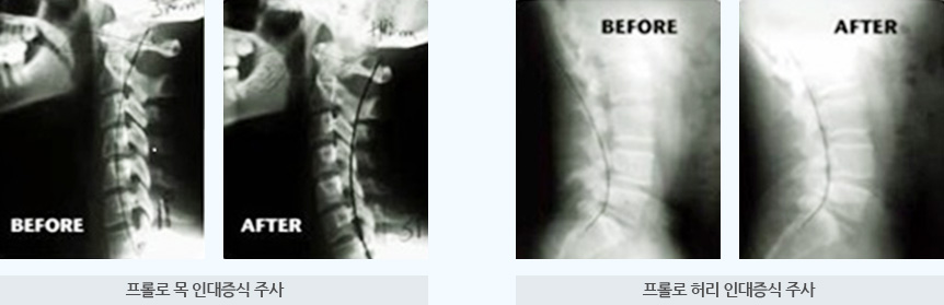 PROLO 테라피 치료방법 이미지