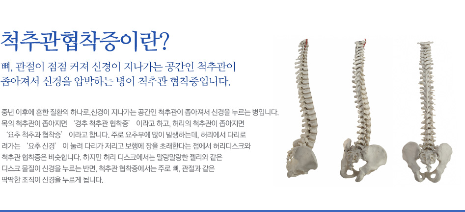 척추관협착증이란? 뼈, 관절이 점점 커져 신경이 지나가는 공간인 척추관이 좁아져서 신경을 압박하는 병이 척추관 협착증입니다. 중년 이후에 흔한 질환의 하나로,신경이 지나가는 공간인 척추관이 좁아져서 신경을 누르는 병입니다. 목의 척추관이 좁아지면 ‘경추 척추관 협착증’ 이라고 하고, 허리의 척추관이 좁아지면 ‘요추 척추과 협착증’ 이라고 합니다. 주로 요추부에 많이 발생하는데, 허리에서 다리로 려가는 ‘요추 신경’ 이 눌려 다리가 저리고 보행에 장을 초래한다는 점에서 허리디스크와 척추관 협착증은 비슷합니다. 하지만 허리 디스크에서는 말랑말랑한 젤리와 같은 디스크 물질이 신경을 누르는 반면, 척추관 협착증에서는 주로 뼈, 관절과 같은 딱딱한 조직이 신경을 누르게 됩니다.
