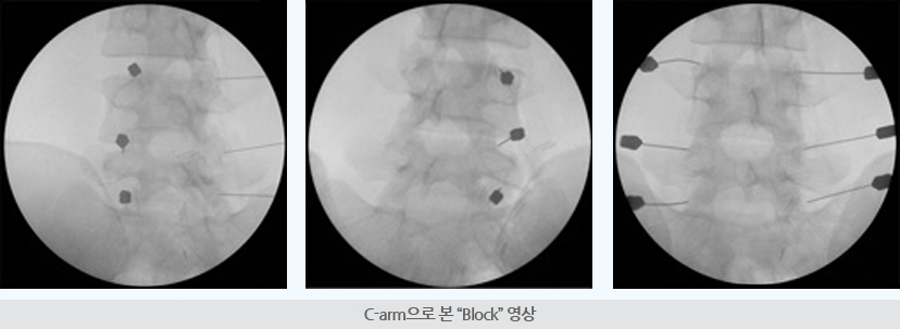 연골조직채취 세포배양(4주) 콘드론 이식술 이식완료