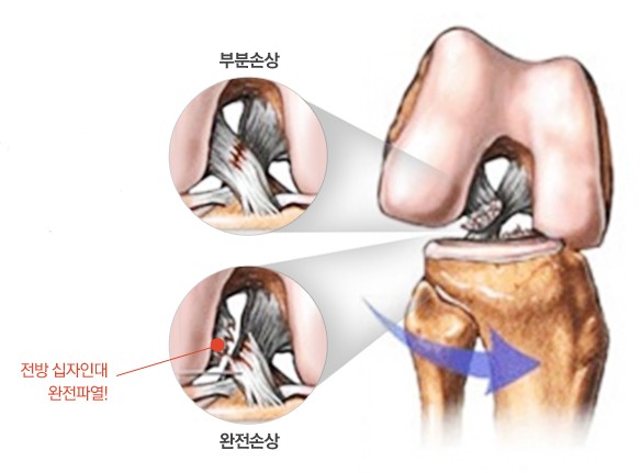십자인대손상 무릎 관절 의학 일러스트