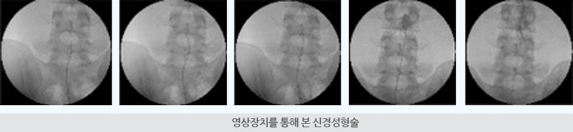 영상장치를 통해 본 신경성형술