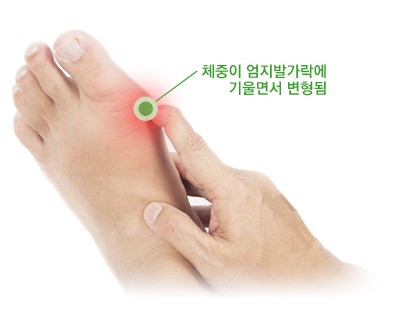 무지외반증 엄지발가락 변형 이미지