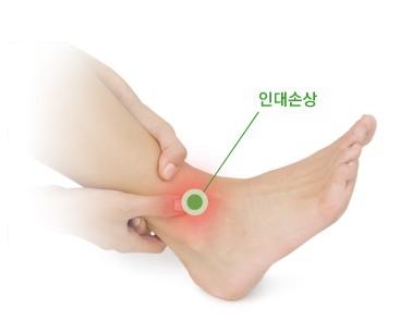 발목인대손상 이미지