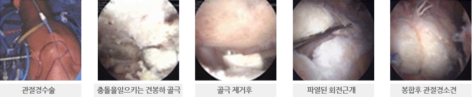 관절경수술, 충돌을일으키는 견봉하 골극, 골극 제거후, 파열된 회전근개의 이미지