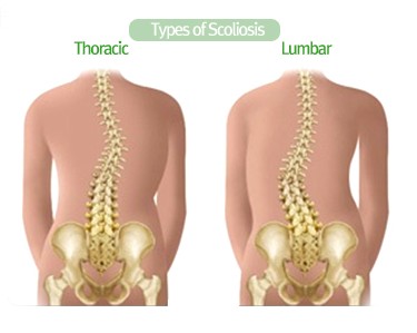 척추측만증 Thoracic&middot;Lumbar 비교 의학 일러스트